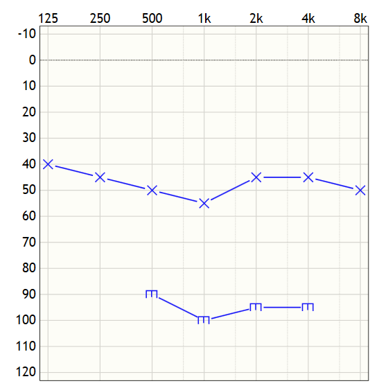 Ein Tonaudiogramm des linken Ohres