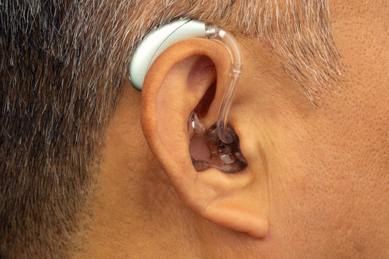 Klassisches Hinter-dem-Ohr-Hörsystem (HdO) mit maßgefertigter Otoplastik zur stabilen und leistungsstarken Versorgung.